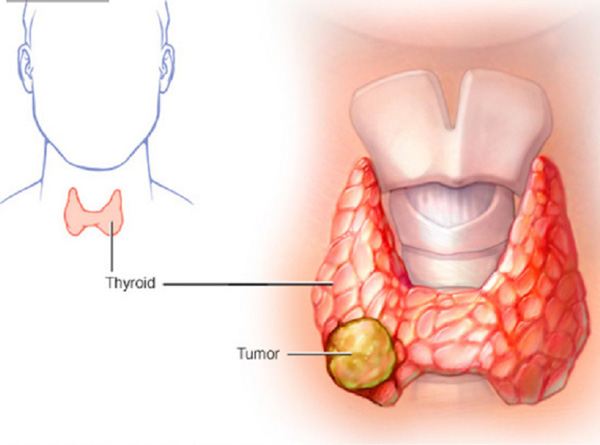 Bệnh ung thư tuyến giáp là gì