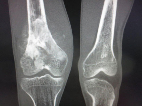 Hình ảnh chụp X-quang khi tầm soát ung thư xương
