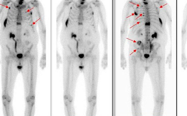 Hình ảnh chụp xạ hình xương tầm soát ung thư xương