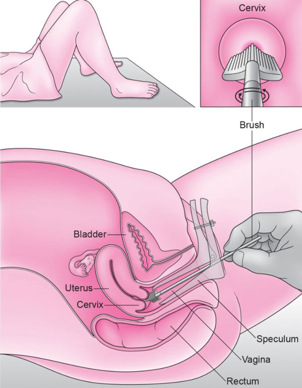 Xét nghiệm tầm soát ung thư cổ tử cung bằng phương pháp phết tế bào 