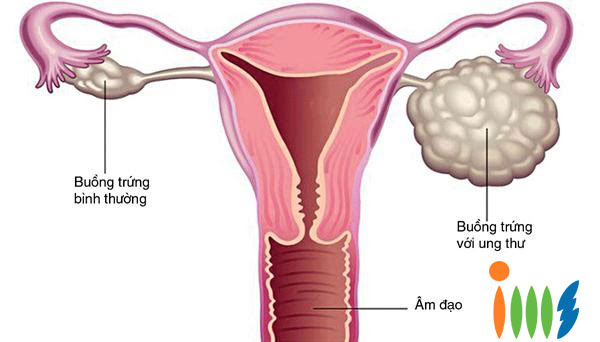 Tỷ lệ mắc bệnh ung thư buồng trứng cao ở nữ giới