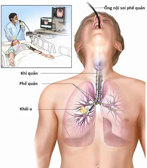 Kiểm tra ung thư phổi bằng phương pháp soi phế quản