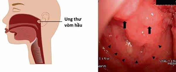 Phương pháp xét nghiệm ung thư vòm họng