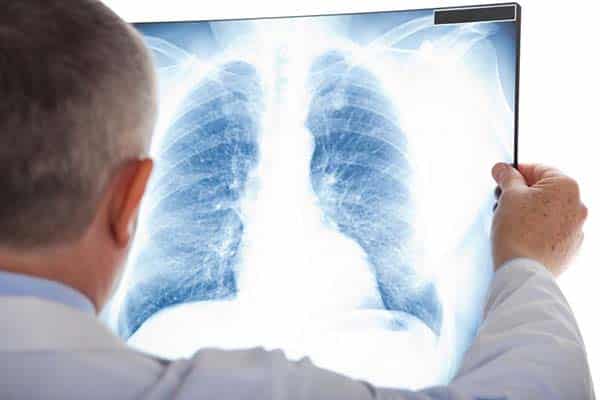 Khám ung thư phổi bằng phương pháp chụp X-quang