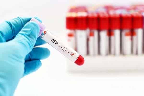 Tầm soát ung thư gan bằng phương pháp xét nghiệm AFP