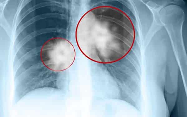 Tầm soát ung thư phổi bằng phươgn pháp chụp X-quang