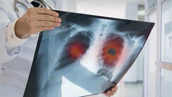 Khám sàng lọc ung thư phổi