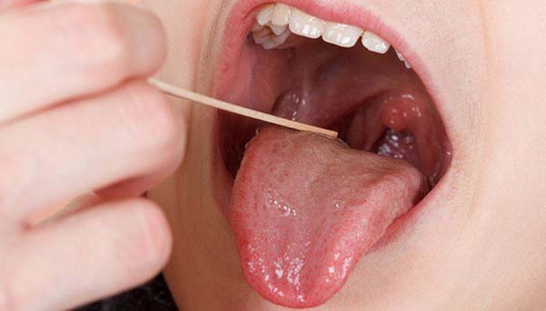 10 cách kiểm tra ung thư miệng chính xác nhất 2024