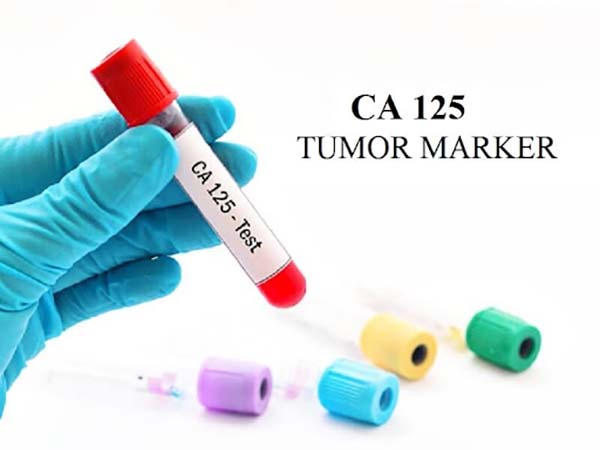 CA 125 là một chất chỉ điểm ung thư buồng trứng