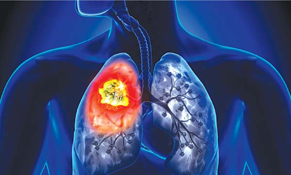 Chi phí hóa trị ung thư phổi 