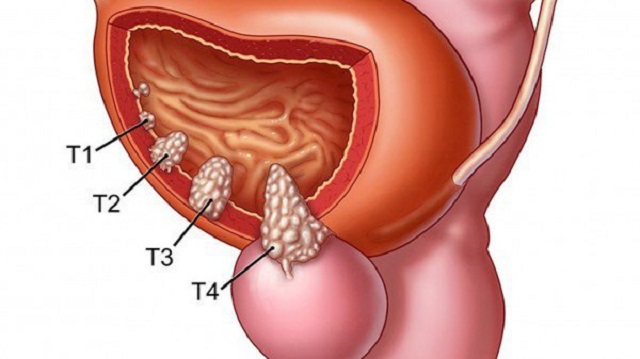 Tỉ lệ sống sót của bệnh ung thư bàng quang