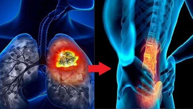 Ung thư phổi di căn xương sống được bao lâu?