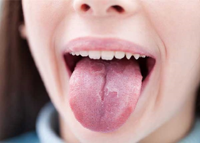 Người bệnh ung thư lưỡi sống được bao lâu?