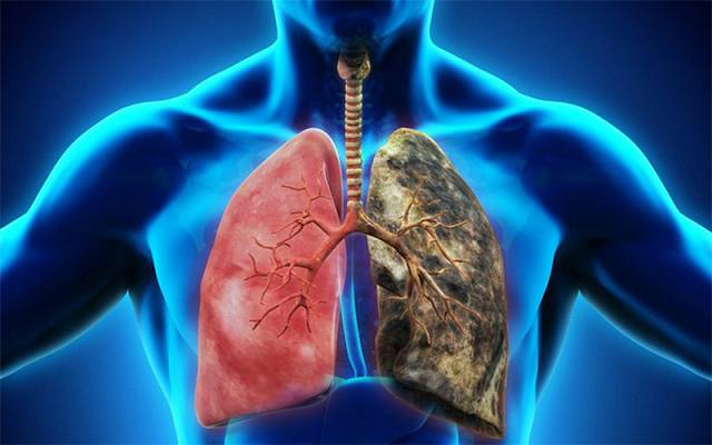 Hút thuốc lá là một trong những nguyên nhân gây ung thư phổi hàng đầu         