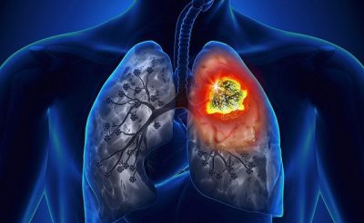 Ung thư phổi không phải là bệnh do vi khuẩn, virus gây ra nên không lây nhiễm cho người khỏe mạnh