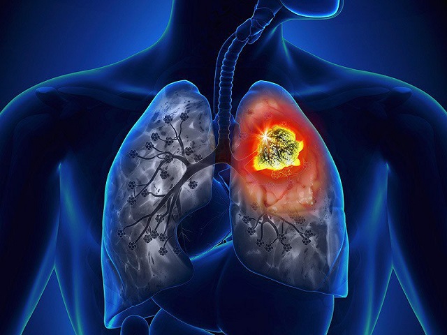 Ung thư phổi không phải là bệnh do vi khuẩn, virus gây ra nên không lây nhiễm cho người khỏe mạnh