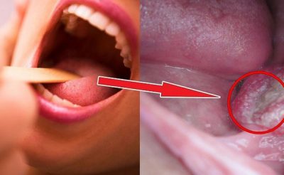 Virus HPV gây bệnh ung thư vòm họng có thể truyền nhiễm thông qua đường tình dục