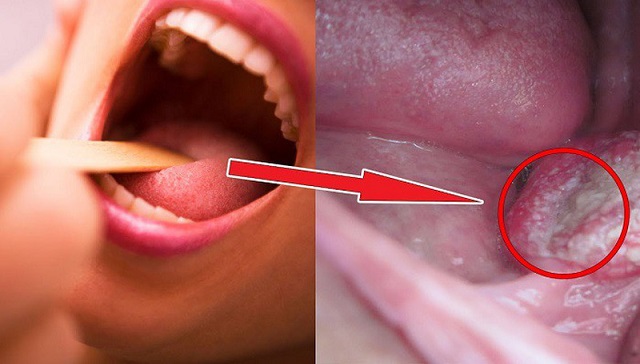 Virus HPV gây bệnh ung thư vòm họng có thể truyền nhiễm thông qua đường tình dục