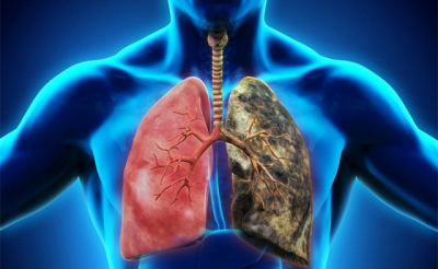 Ung thư phổi có thể điều trị tích cực ở những giai đoạn sớm 