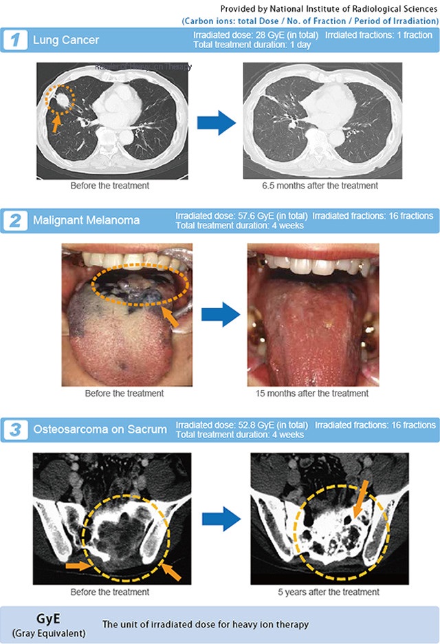 Hình ảnh kết quả điều trị hiệu quả ung thư phổi bằng phương pháp xạ trị ion nặng tại Nhật Bản - Hình ảnh: NIRS