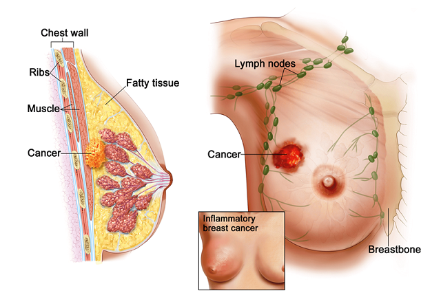Ung thư vú có thể điều trị và hồi phục thành công nếu được chẩn đoán và có phương án trị liệu phù hợp 