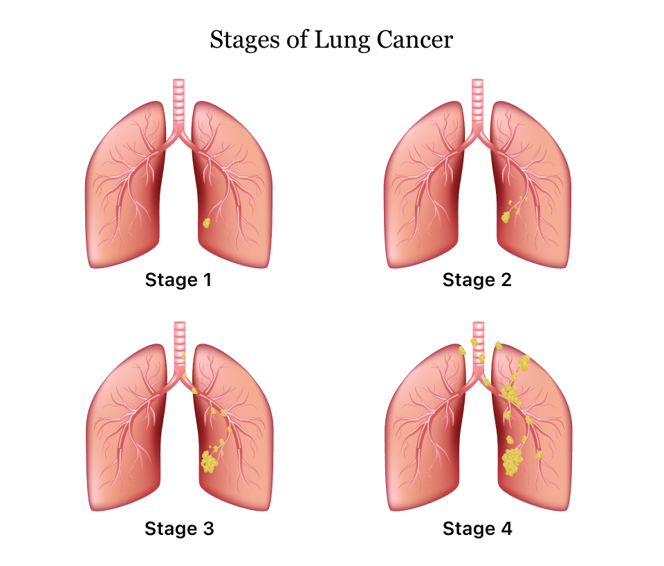 Ung thư phổi tế bào nhỏ và ung thư phổi không tế bào nhỏ