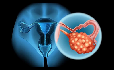 Ung thư buồng trứng nếu không được điều trị kịp thời có thể gây ảnh hưởng đến khả năng sinh sản của phụ nữ