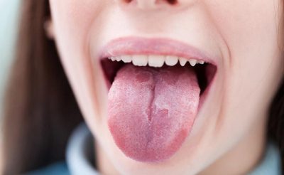 Ung thư lưỡi không có nhiều triệu chứng đặc trưng nên khó phát hiện nhanh chóng ở những giai đoạn sớm