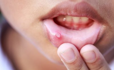 Ung thư miệng không có nhiều triệu chứng đặc trưng khiến người bệnh khó phát hiện, bỏ qua thời điểm tốt nhất để điều trị
