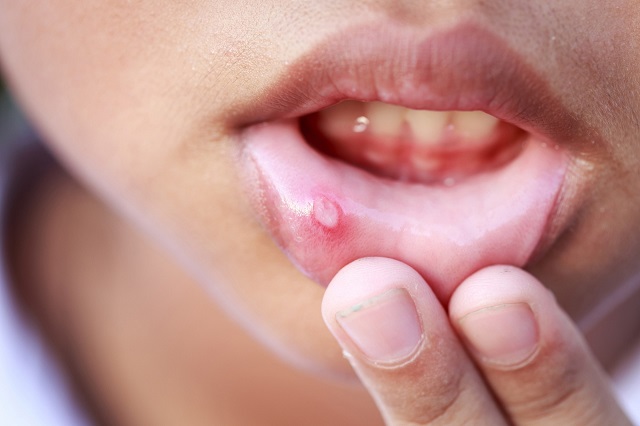 Ung thư miệng không có nhiều triệu chứng đặc trưng khiến người bệnh khó phát hiện, bỏ qua thời điểm tốt nhất để điều trị