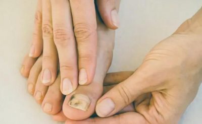 Khi các vùng móng tay, móng chân xuất hiện các vết đen bất thường có thể là dấu hiệu của ung thư tế bào hắc tố ở móng 