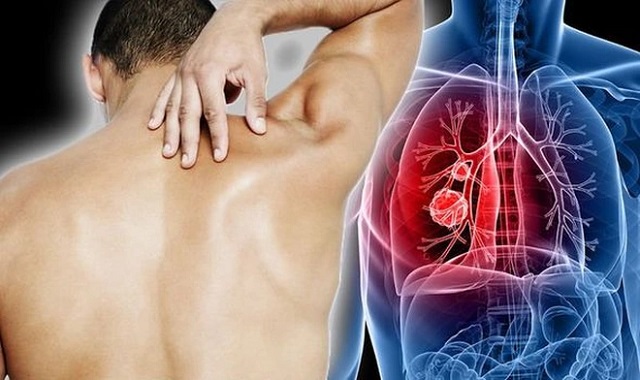 Khối u ung thư phổi có thể chèn ép lên các dây thần kinh ở vùng lưng gây đau vai, nhức mỏi