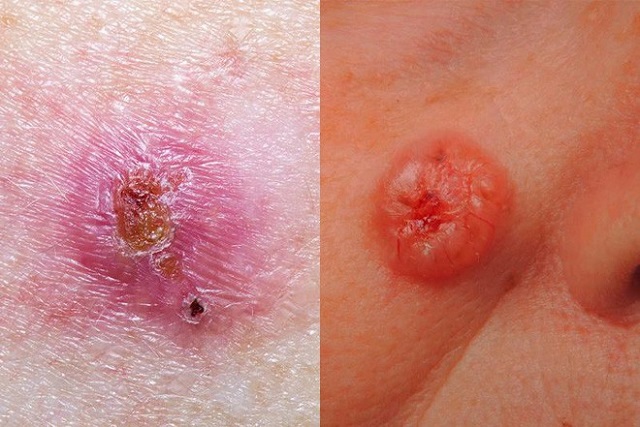 Người bệnh thường chủ quan trước những dấu hiệu như vết u nhỏ, màu sắc khác thường