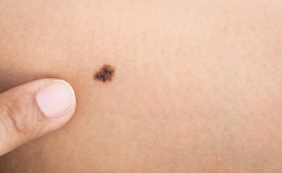 Thay đổi kích thước nốt ruồi bất thường cũng là dấu hiệu ung thư da phổ biến