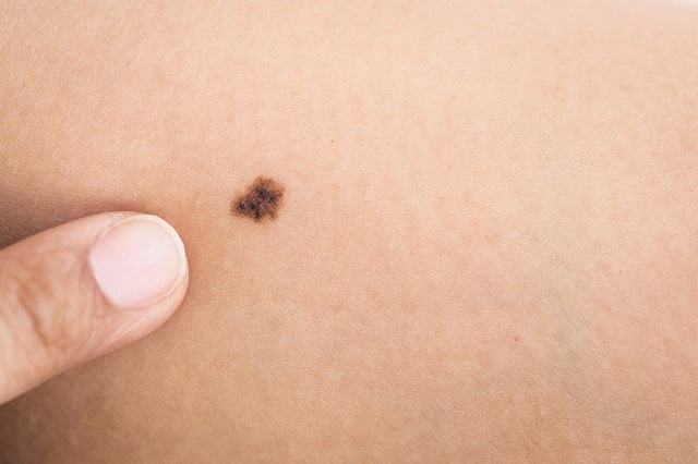 Thay đổi kích thước nốt ruồi bất thường cũng là dấu hiệu ung thư da phổ biến