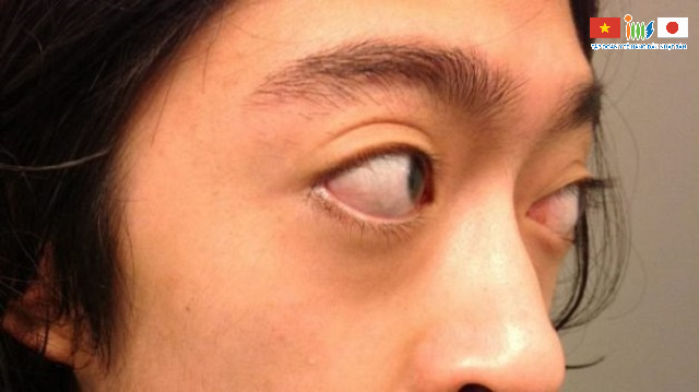 Càng ở giai đoạn muộn của ung thư mắt, tình trạng lồi mắt sẽ ngày càng nặng hơn 