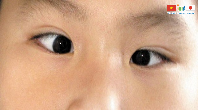 Lác mắt có thể là dấu hiệu ung thư mắt phổ biến mà bạn không nên bỏ qua