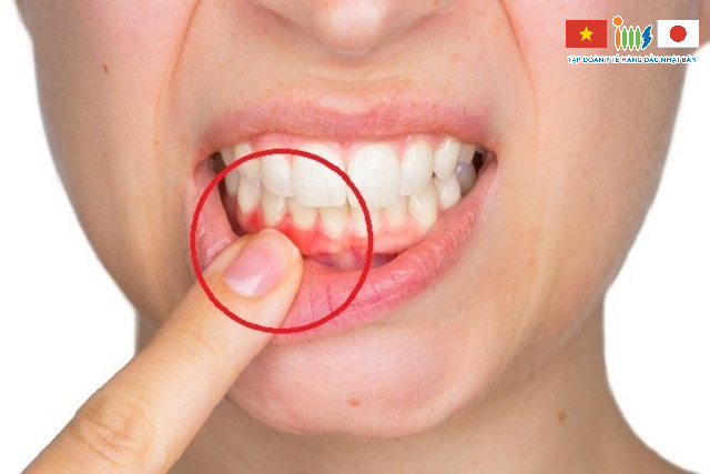 Răng lung lay bất thường cũng là một trong những dấu hiệu ung thư khoang miệng đặc trưng