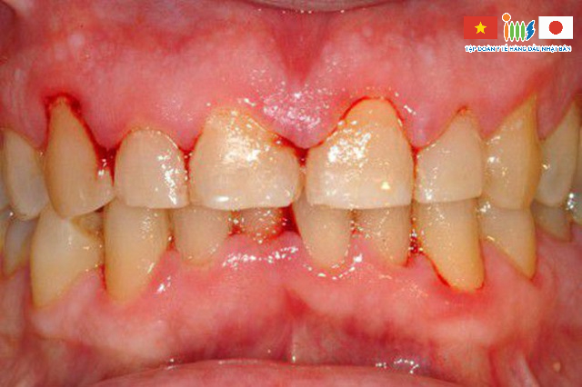 Ung thư khoang miệng khiến răng dễ bị tổn thương, chảy máu khi có tác động, va chạm nhẹ