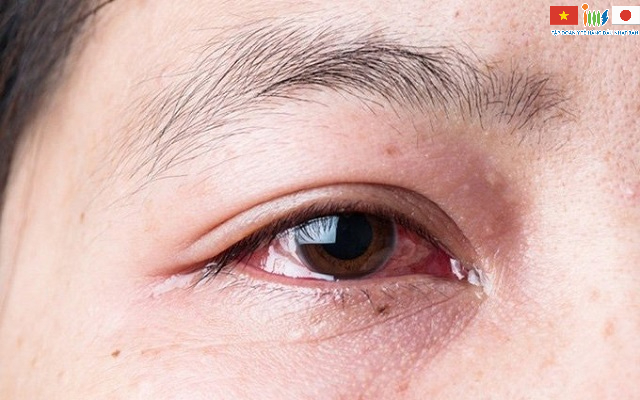 Các tổn thương vùng mũi có thể kích thích kết mạc, giác mạc làm người bệnh chảy nước mắt liên tục