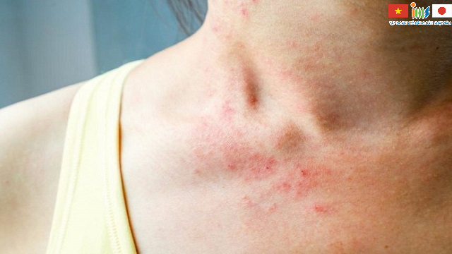 Khi thấy da xuất hiện các mảng, ngứa ngáy khó chịu có thể là dấu hiệu cảnh báo ung thư tuyến tụy