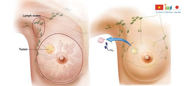 Các tế bào ác tính ở mô tuyến vú phát triển bất thường có thể gây nên tình trạng ung thư vú