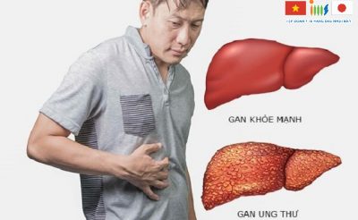 Ung thư gan là căn bệnh có tỷ lệ tử vong cao nhất trong danh sách các bệnh ung thư phổ biến của Việt Nam