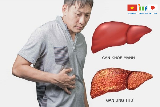 Ung thư gan là căn bệnh có tỷ lệ tử vong cao nhất trong danh sách các bệnh ung thư phổ biến của Việt Nam
