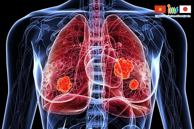 Ung thư phổi di căn đến các cơ quan lân cận khiến cơ thể suy giảm chức năng hoạt động, có thể dẫn đến tử vong