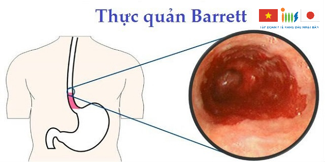 Bệnh viêm thực quản Barrett không điều trị kịp thời dễ dẫn đến ung thư thực quản 