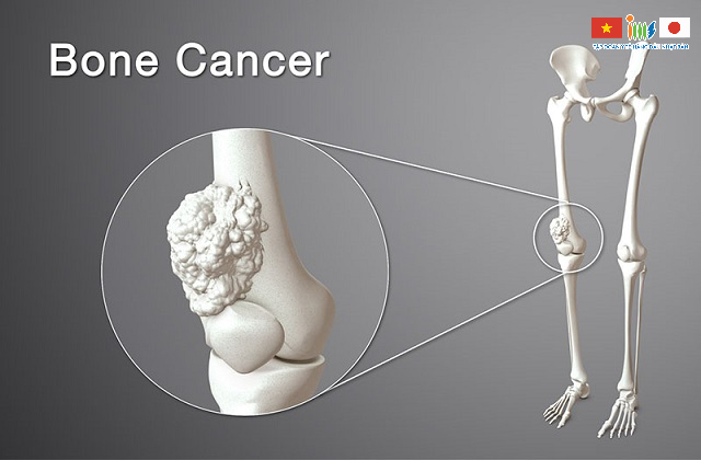 Đột biến gen làm tăng nguy cơ mắc ung thư xương có thể di truyền từ thế hệ này sang thế hệ khác
