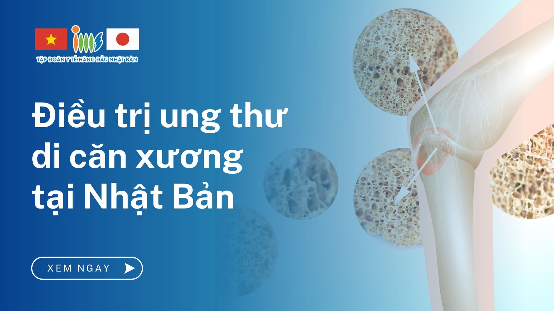 Phương pháp điều trị ung thư di căn xương tại Nhật Bản