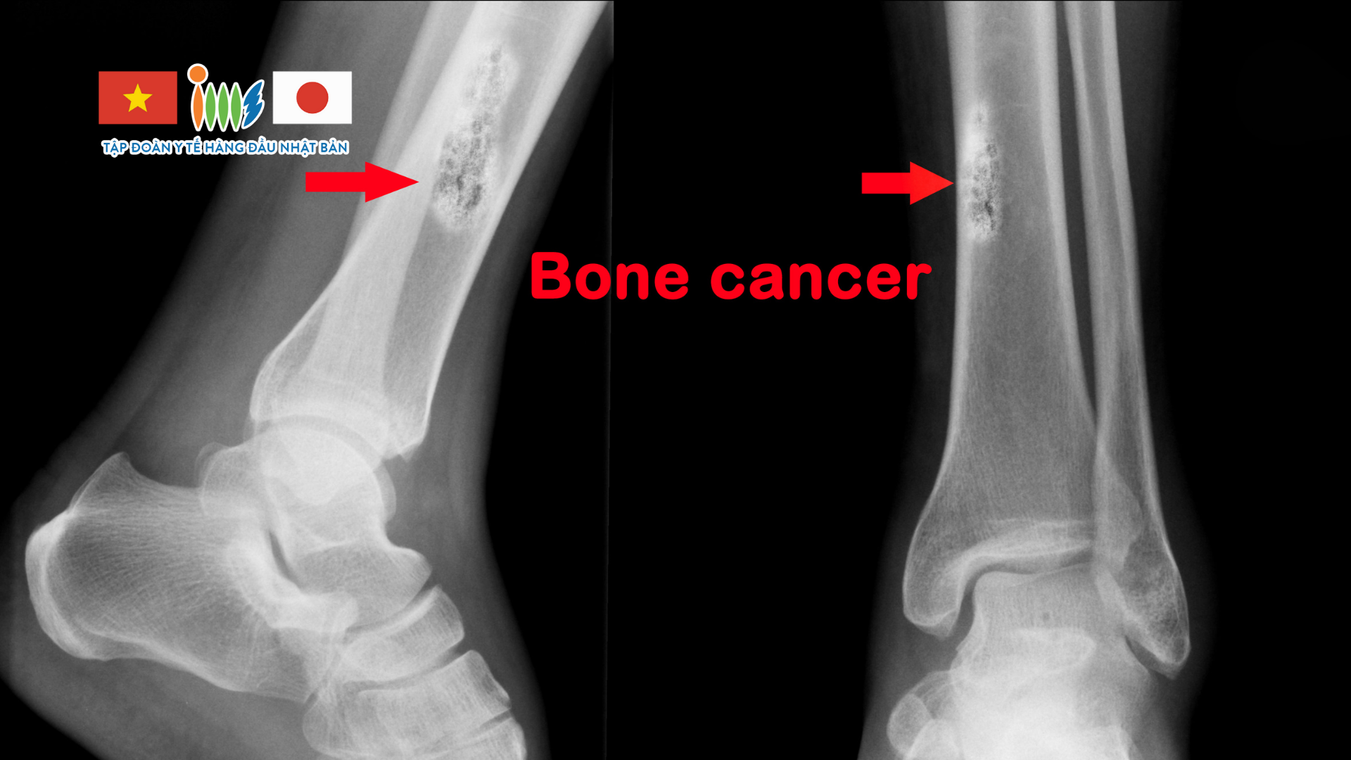 Điều trị ung thư di căn xương tại Nhật có hiệu quả không?