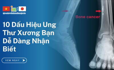 10 Dấu Hiệu Ung Thư Xương Bạn Dễ Dàng Nhận Biết